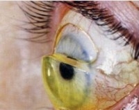 Ptosis scleralens