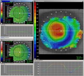 Topografie na ortho-k bij hyperopia Topografie na ortho-k bij hyperopia