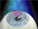 Lasik methode