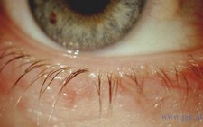 Korstjes, schilfertjes aan de ooglidranden bij blefaritis