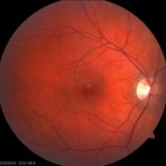 Fundus foto (JGK)