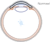Schematische voorstelling van een normale oogvorm