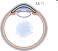 Schematische voorstelling van een milde keratoconus