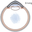 Schematische voorstelling van een ernstige keratoconus.