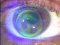 Fluorescentiebeeld bij een contactlensaanpassing bij keratoconus