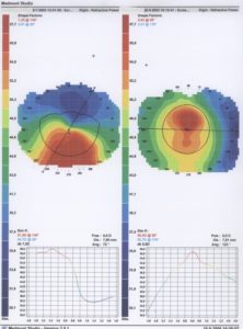 Topografie bij een keratoconus