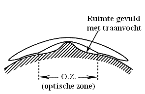 Schematische voorstelling van een keratoconus correctie