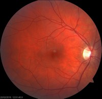 Fundus rechter oog