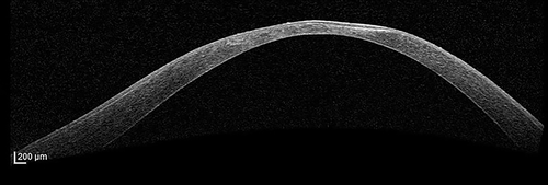 oct-keratoconus oct-kc